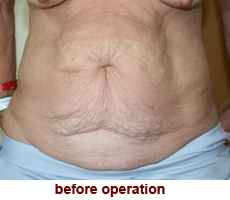 plastic-surgery-tummy-tuck